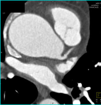 cardiac 64 mdct