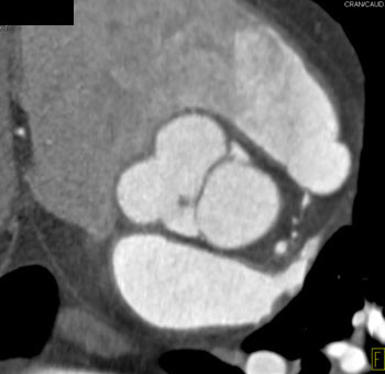 cardiac 64 mdct