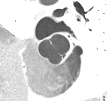 cardiac 64 mdct