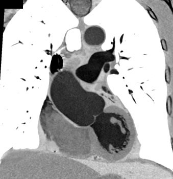 cardiac 64 mdct