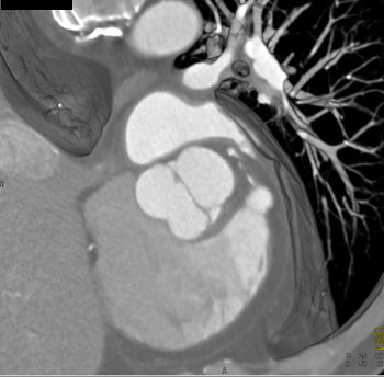 cardiac 64 mdct