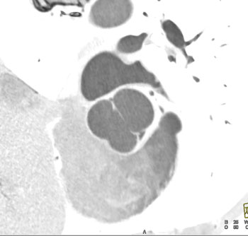 cardiac 64 mdct