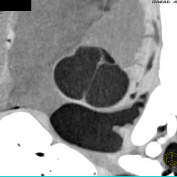 cardiac 64 mdct