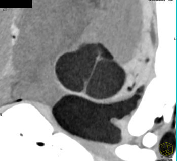 cardiac 64 mdct