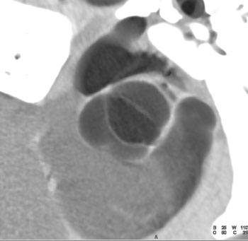 cardiac 64 mdct