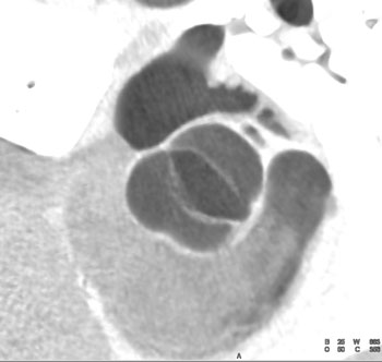 cardiac 64 mdct