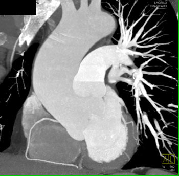 cardiac 64 mdct