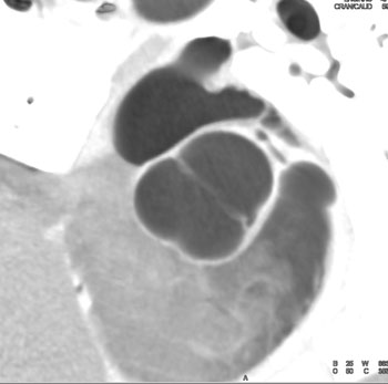 cardiac 64 mdct