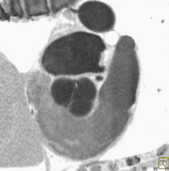 cardiac 64 mdct