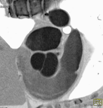 cardiac 64 mdct