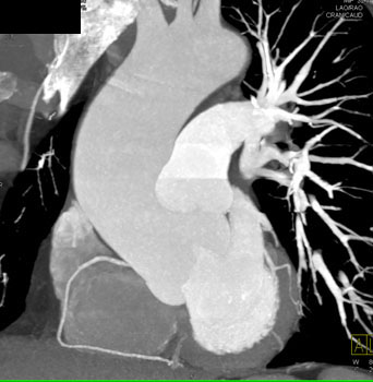 cardiac 64 mdct