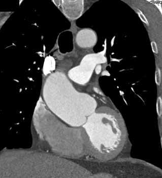 cardiac 64 mdct