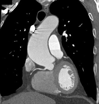 cardiac 64 mdct