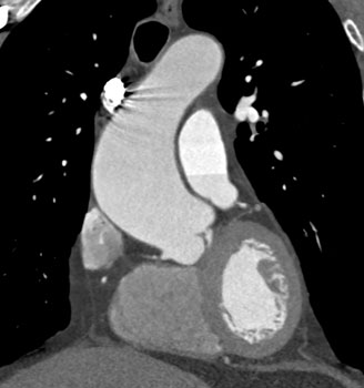 cardiac 64 mdct