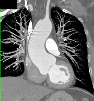 cardiac 64 mdct