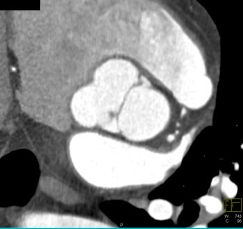 cardiac 64 mdct