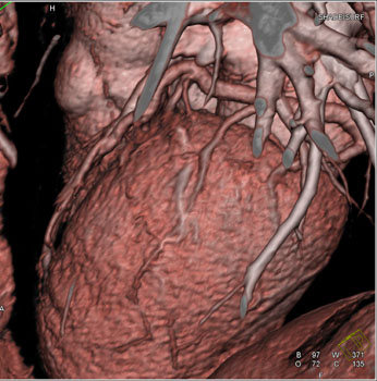 cardiac 64 mdct