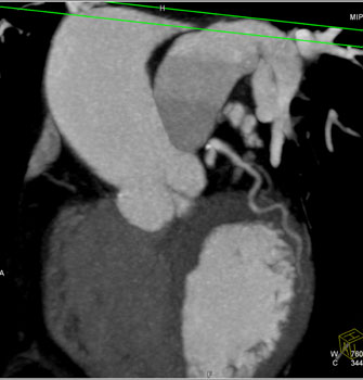 cardiac 64 mdct