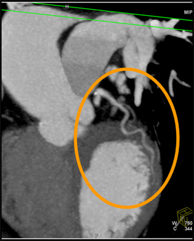 cardiac 64 mdct