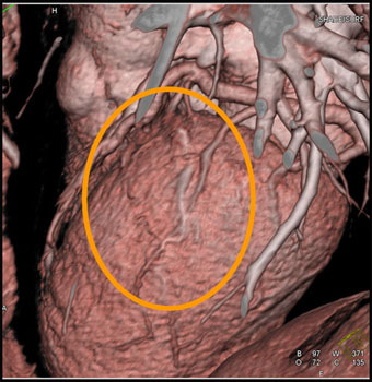 cardiac 64 mdct