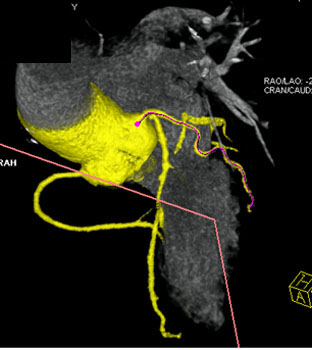 cardiac 64 mdct