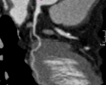 cardiac 64 mdct