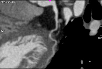 cardiac 64 mdct