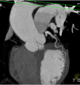 cardiac 64 mdct