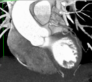 cardiac 64 mdct