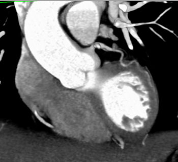 cardiac 64 mdct