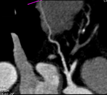 cardiac 64 mdct