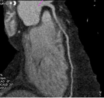 cardiac 64 mdct