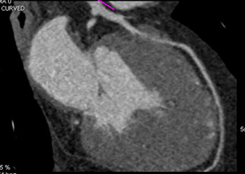 cardiac 64 mdct