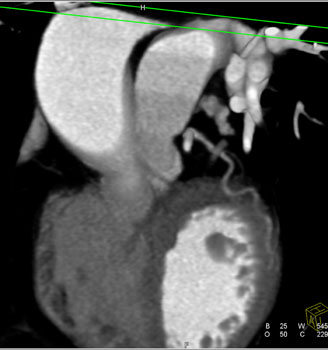 cardiac 64 mdct