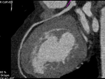 cardiac 64 mdct