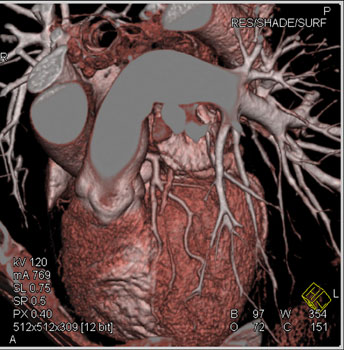 cardiac 64 mdct