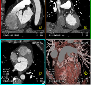 cardiac 64 mdct