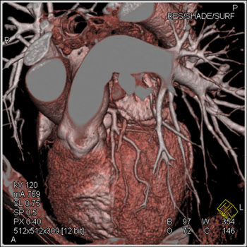 cardiac 64 mdct