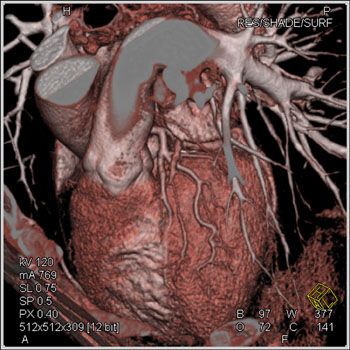 cardiac 64 mdct