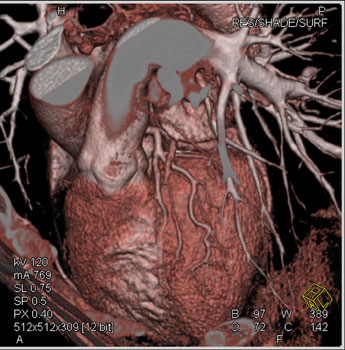 cardiac 64 mdct