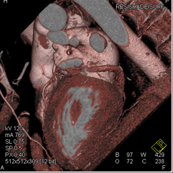 cardiac 64 mdct