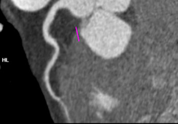 cardiac 64 mdct