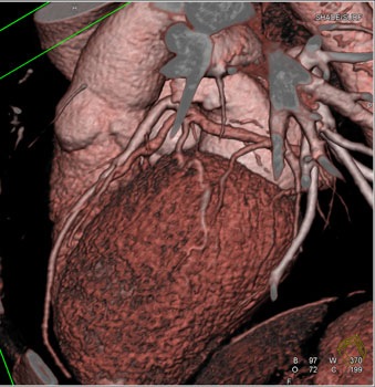 cardiac 64 mdct