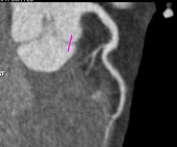 cardiac 64 mdct