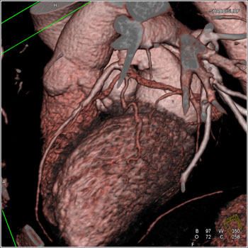 cardiac 64 mdct