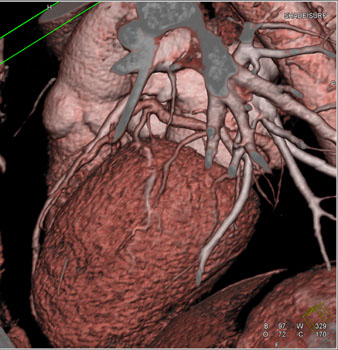 cardiac 64 mdct