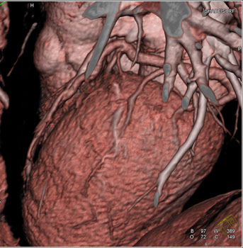 cardiac 64 mdct