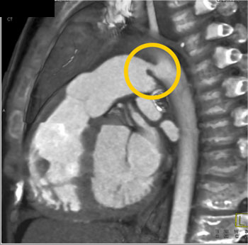 cardiac 64 mdct