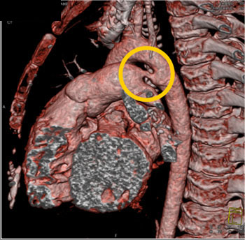 cardiac 64 mdct