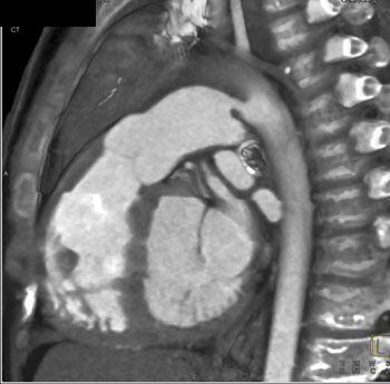 cardiac 64 mdct